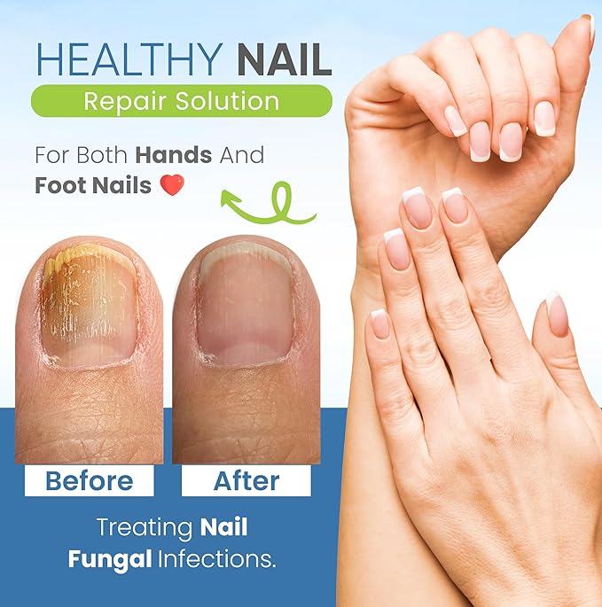 Best Nail Fungus Treatment